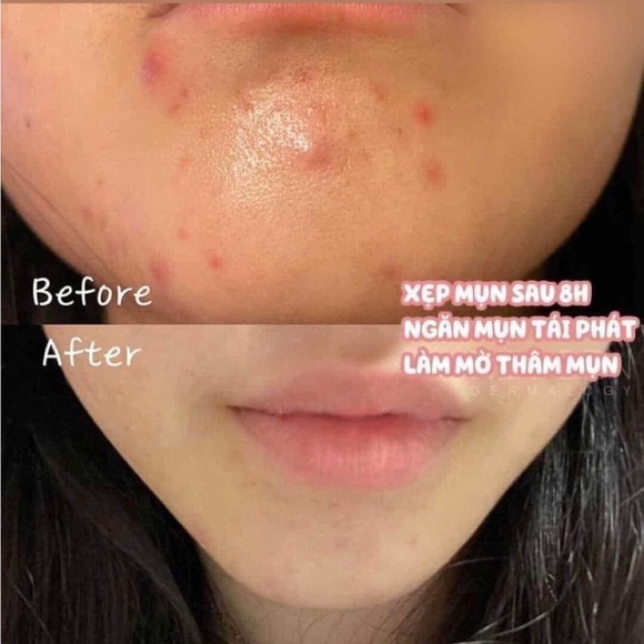 VELY VELY S.O.S Spot Powder - Acne , Blemish Rescue Treatment ( Pack of 2 ) - Picture 6 of 6